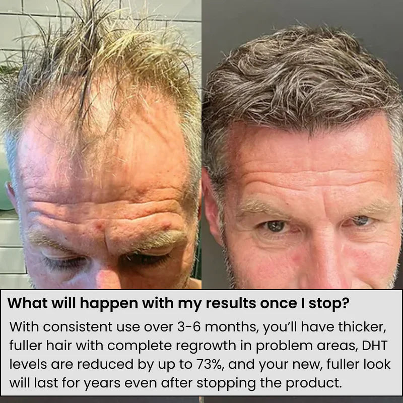 Microneedle Infusion Hair Regrowth Solution