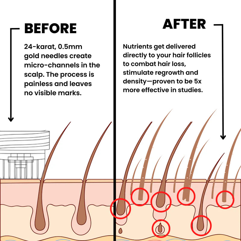 Microneedle Infusion Hair Regrowth Solution