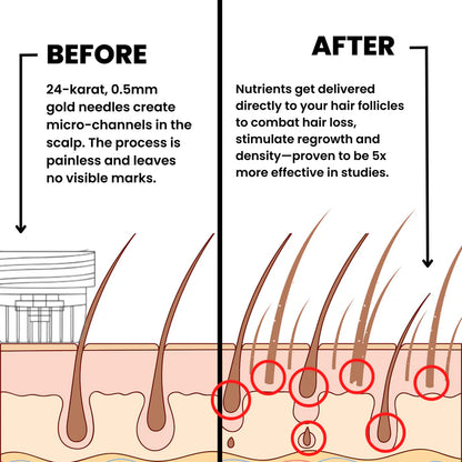 Microneedle Infusion Hair Regrowth Solution