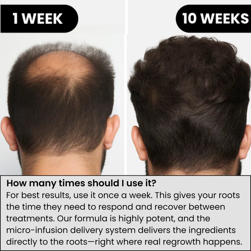 Microneedle Infusion Hair Regrowth Solution