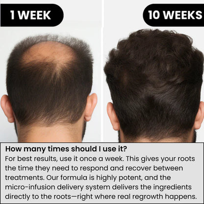 Microneedle Infusion Hair Regrowth Solution