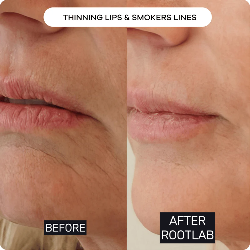Skin Care Collagen Polypeptide Microneedle Suit