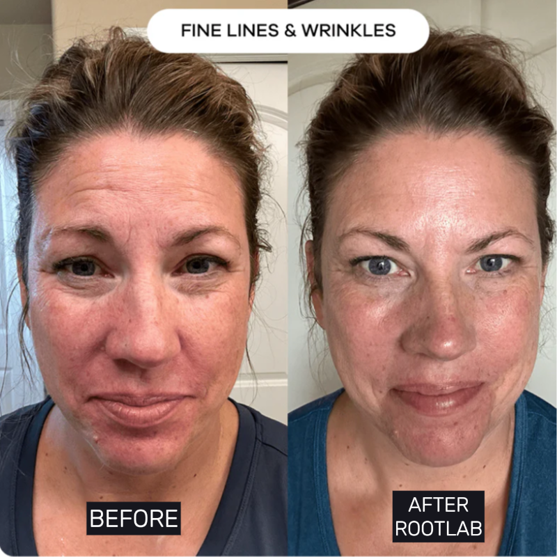 Skin Care Collagen Polypeptide Microneedle Suit