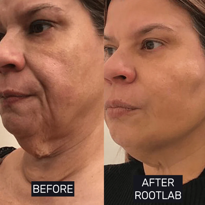Skin Care Collagen Polypeptide Microneedle Suit