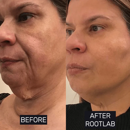 Skin Care Collagen Polypeptide Microneedle Suit