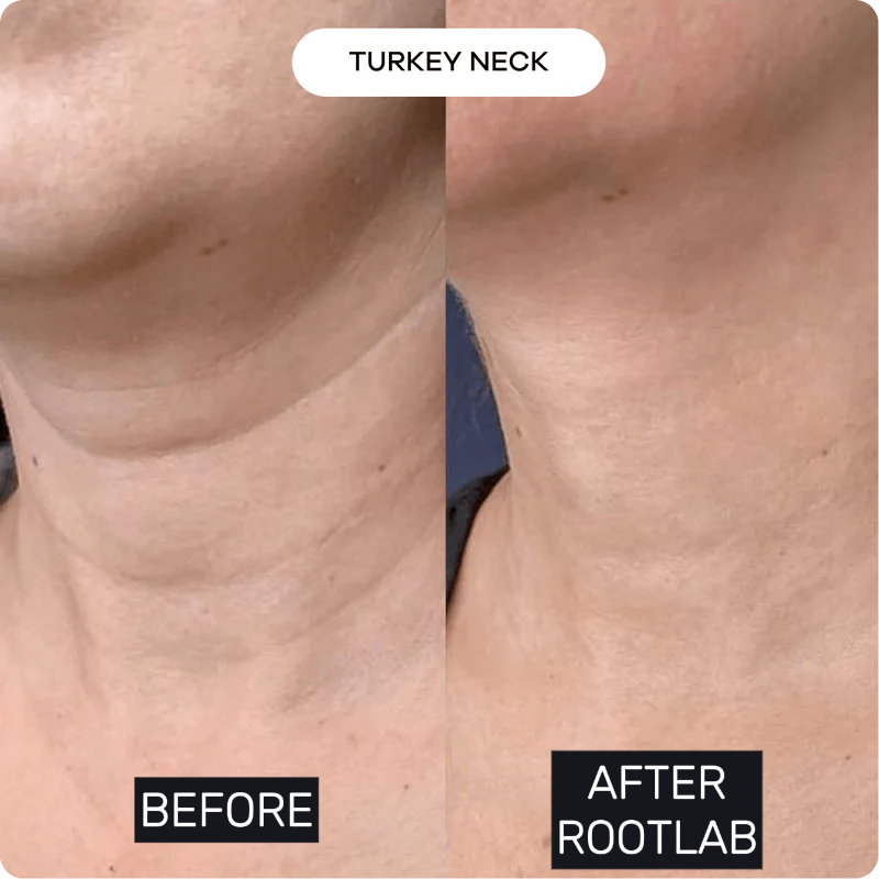 Skin Care Collagen Polypeptide Microneedle Suit